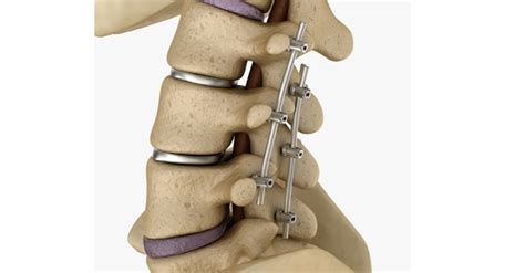 Spinal Fusion Purpose Preparation Procedure Aftercare Risks
