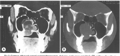 Figure 2 From Brown Tumor Of The Palate In A Patient With Primary