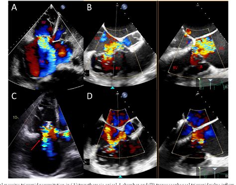 Figure 1 From First Percutaneous Tricuspid Valve Repair With Mitraclip