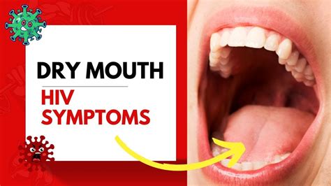 Dry Mouth Hiv Symptoms Youtube