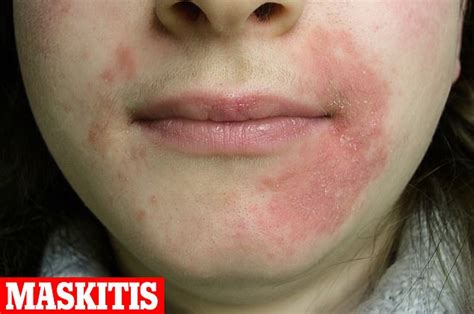 Are You Suffering From Maskitis A Painful Rash Caused By Face Masks