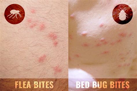 Flea Bites Compared To Bed Bug Bites Accorha