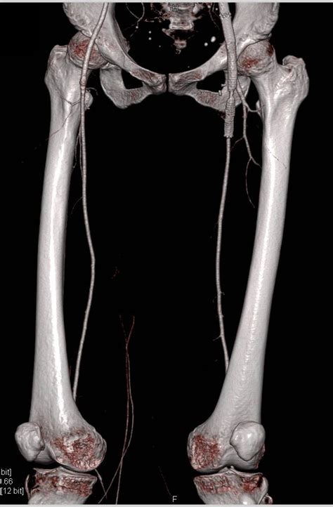 Near Occlusion Short Segment Of Stent In Left Superficial Femoral