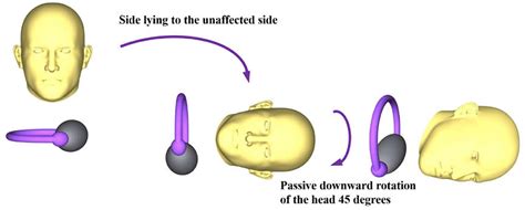 Frontiers Case Report New Application Of A Gufoni Maneuver Variation