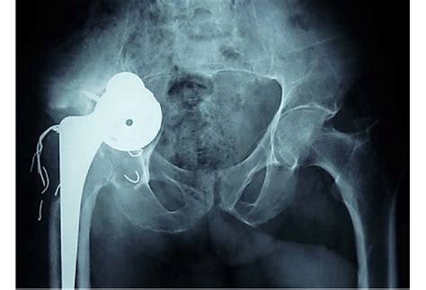 Anteroposterior X Ray Of The Pelvis Showing Acetabular Component