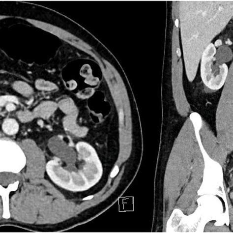 Contrast Enhanced Ct Of The Abdomen And Pelvis Axial Left And