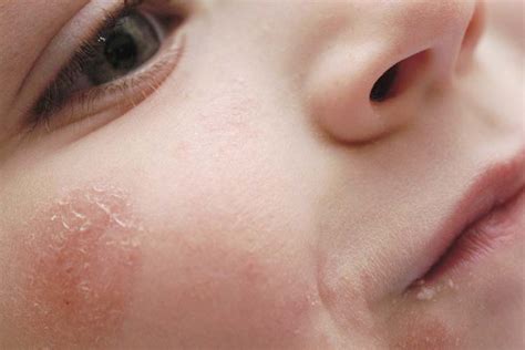 allergie  nurofen chez  enfant   symptomes dune reaction