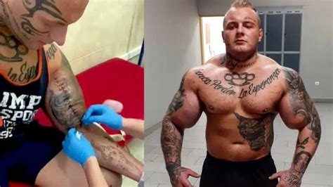 Bodybuilder Known As Polish King Of Synthol Undergoes Gruesome Operation For Inch Biceps