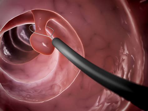 A colon often precedes an explanation, a list, or to introduce a quoted sentence. Colon Polyps & Colon Cancer Risk