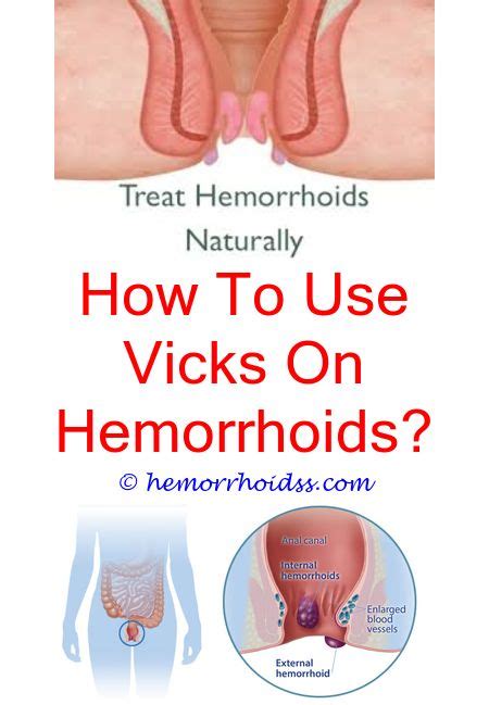 How To Get Rid Of Hemorrhoids Naturally Fast And Easy Hemorrhoids Treatment Bleeding