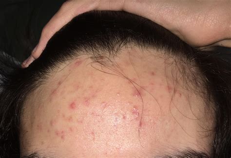 Acne Could This Be Fungal Acne Rskincareaddiction