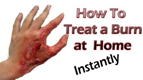 Well, i can put a link to a video i like on youtube so my friends can watch it too. How to Treat A Burn Naturally - YouTube