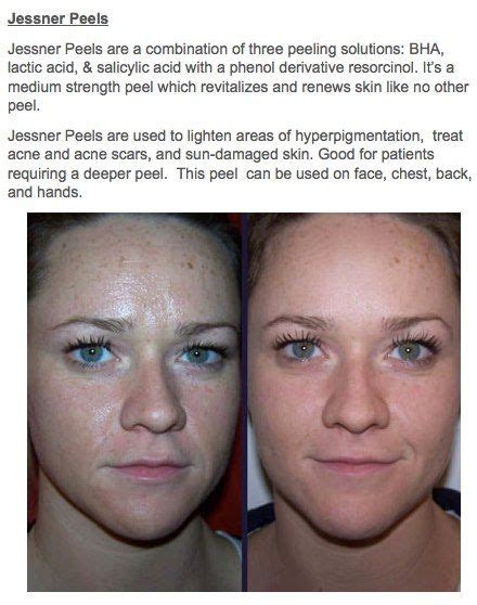 See The Results For Your Self Jessners Peel Officepeel Natural