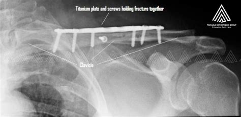 Clavicle Fracture Surgery Singapore Shoulder Sports Surgeon