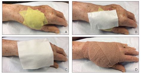 Dressing Technique To Optimize Wound Healing After Mohs