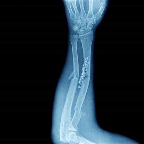 Broken Bone Xray Stock Photos Pictures And Royalty Free Images Istock