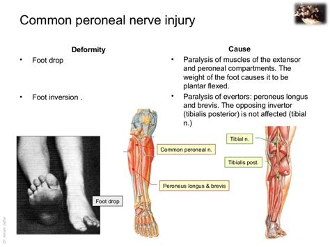 Applied Anatomy Common Peroneal Nerve Injury
