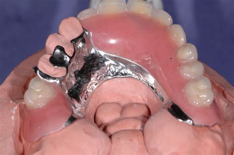 Full And Partial Dentures Wiand Dental Lab