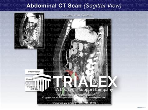 Ct Scan Of The Abdomen Sagittal View Trial Exhibits Inc