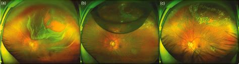 25 Gauge Pars Plana Vitrectomy Combined With Air Tamponade For Primary