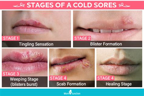 Blister On Lip That Is Not A Cold Sore