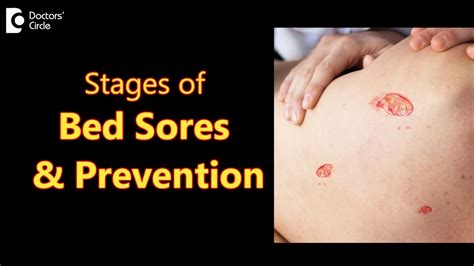 Bed Sores Decubitus Ulcers Stages Causes Symptoms And Treatment Dr Aruna Prasad Doctors