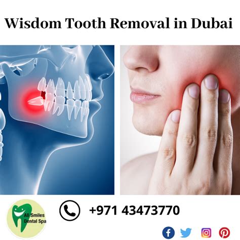 Even if they are impacted, they can become infected from germs from adjacent teeth. Wisdom Tooth Extraction in Barsha - All Smiles Dental Spa ...