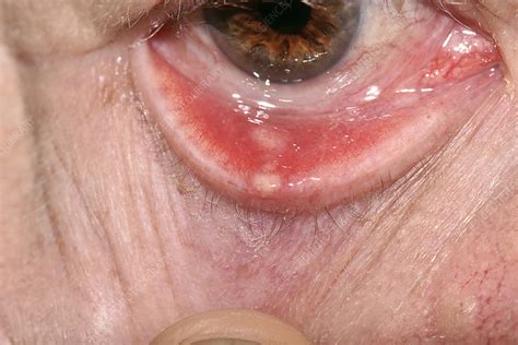 Chalazion Cyst On An Eyelid Stock Image C0401425 Science Photo