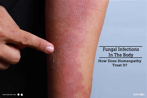 Fungal Infections In The Body How Does Homeopathy Treat It By Dr