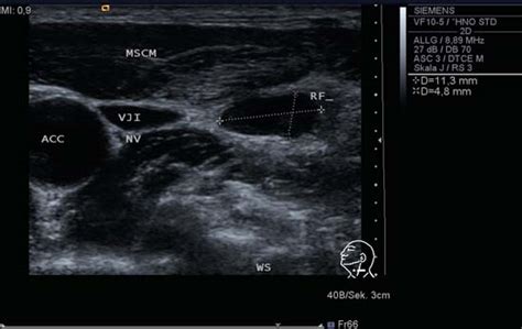 Neck Lymph Nodes Radiology Key