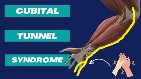Cubital Tunnel Syndrome Anatomy And Treatment Physiotherapist Explains