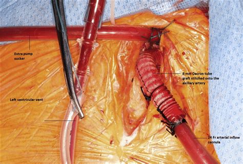 Right Axillary Artery Cannulation Download Scientific Diagram