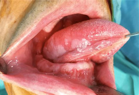 Clinical Stage I T1n0m0 Squamous Cell Carcinoma Of The Tongue