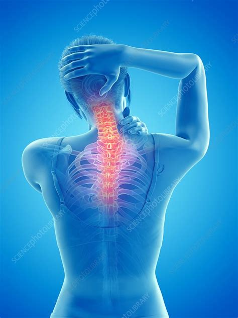 Woman With A Painful Neck Illustration Stock Image F0296374