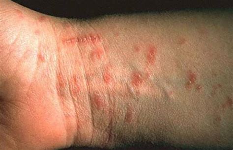 Scabies is a common contagious skin condition caused by the human itch mite. Home Remedies for Scabies Treatment Naturally