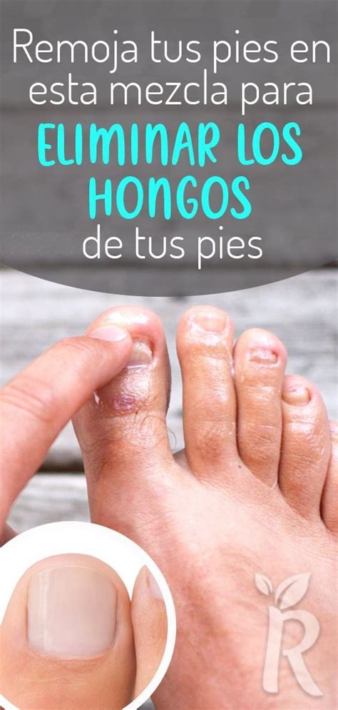 Cuándo debes consultar con un médico. Remedios para hongos en los pies, hongos uñas, pie de ...