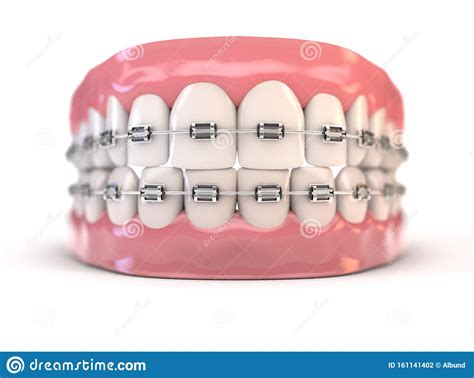 Fake Teeth Set With Braces Stock Illustration Illustration Of Flesh