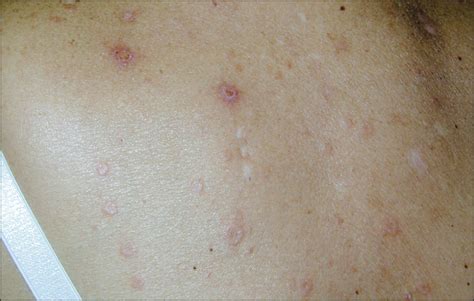 Interstitial Granulomatous Dermatitis Associated With The Use Of Tumor