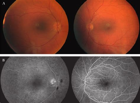 A Right Ophthalmic Fundus Revealing A Papillitis That Was Associated