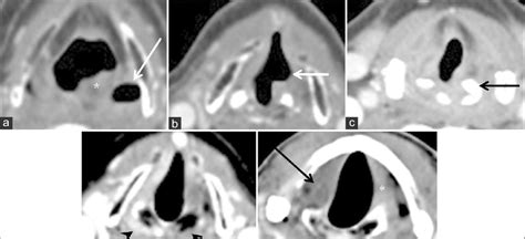 Axial Ct Images Demonstrate Imaging Features Of Vocal Fold Paralysis