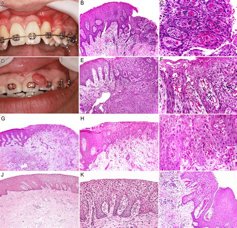 Typical Ljsgh Case Affecting The Maxillary Gingiva A Microscopically