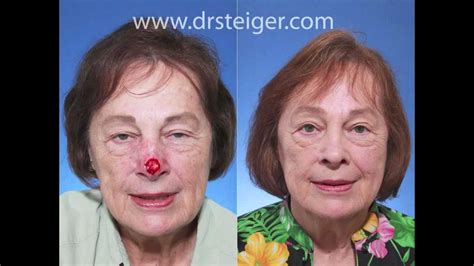 Nasal Reconstruction With A Forehead Flap In South Florida Youtube