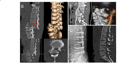 A Computed Tomography Ct Showed L3 Vertebral Burst Fracture With