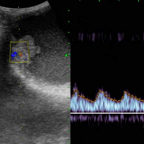 We did not find results for: Malignant Mesothelioma of the Tunica Vaginalis Testis ...