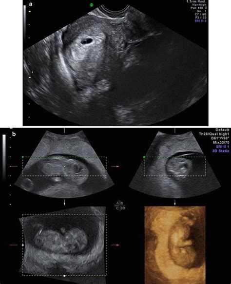 First Trimester Ultrasound Anatomy