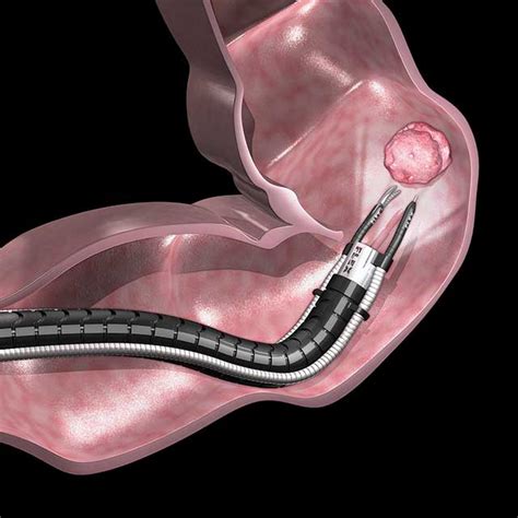 Johns Hopkins Among First To Offer Flexible Robotic Endoscopy