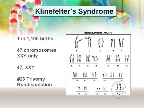 Medical Genetics Lecture Klinefelter Turner Down Syndrome Muhammad