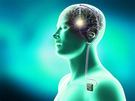 Deep Brain Stimulation Dbs Treat Parkinson Disease Free Consultation