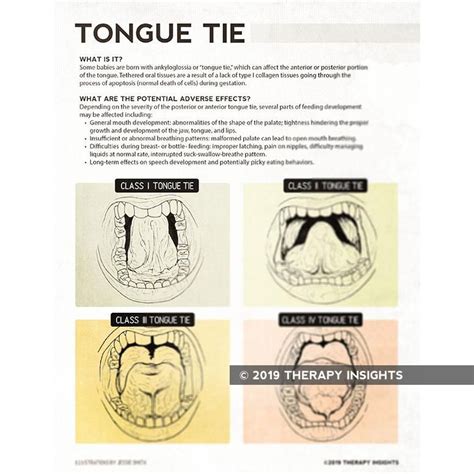 Handout Tongue Tie Tongue Tie Speech Therapy Tools Handouts
