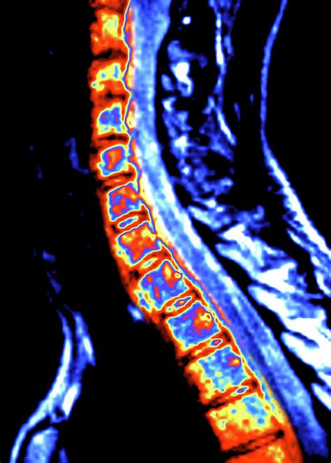 Ct Scan Of Spine Photograph By Alfred Pasiekascience Photo Library